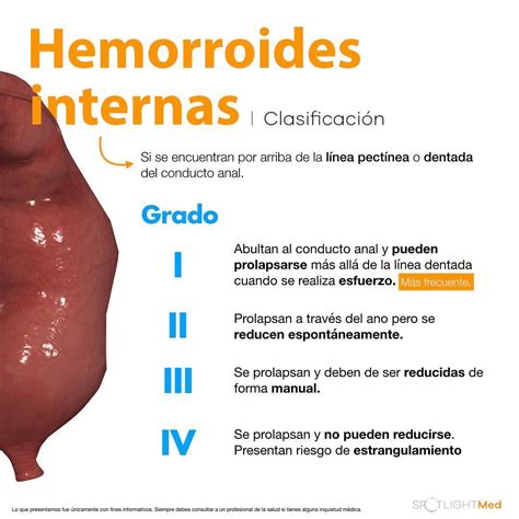 hemorroides internas-4